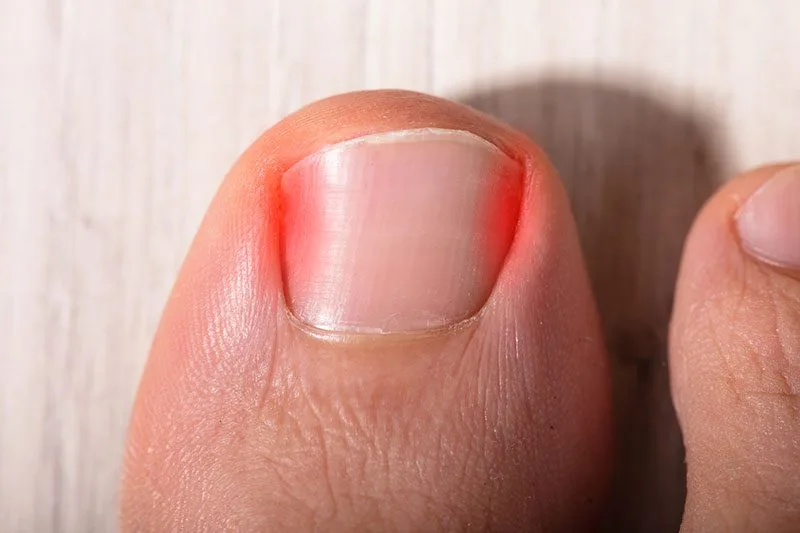 Toe Nail Conditions