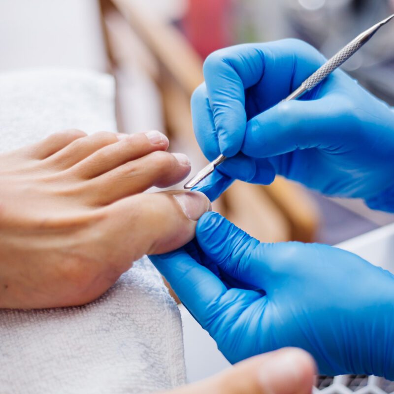 fungal nail treatment